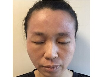 花銀クラブ(花銀Club)/通院でも治らないM様がADSで→→