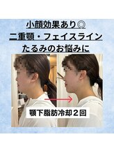 ルーチェエムベルシック(Luce.MBelChic)/顎下の脂肪冷却