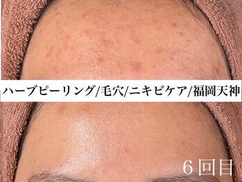 ホワイトアクア 福岡天神店(WHITE AQUA)/ハーブピーリングビフォー