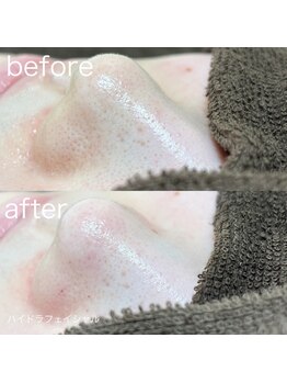 ルルラ リコ(lulula rico)/症例写真/ハイドラ毛穴洗浄