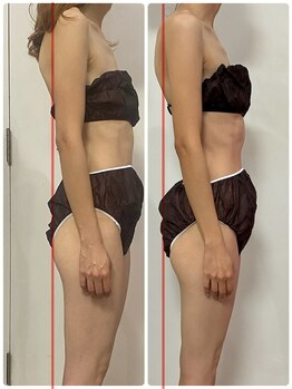 ランス/骨の歪みが改善してきました