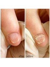 リネイル 長浜(Re-na-iL)/ネイルケア＆スパ¥7000