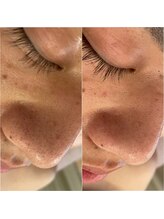 ミュレア 新宿本店(mulea)/【ハイドラフェイシャル】