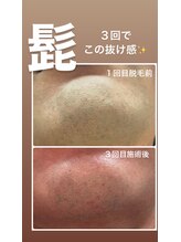 リンカ(Rinca)/髭脱毛！効果ズバリ120点満点