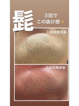 リンカ(Rinca)/髭脱毛！効果ズバリ120点満点