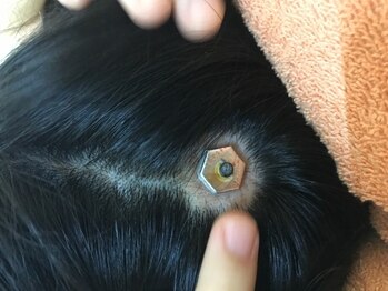 一樹鍼灸院/育毛を促進させます