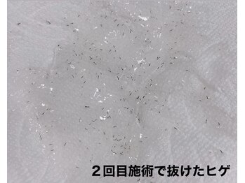 メンズー(MENZOO)/【お客様写真】ヒゲ脱毛