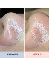 ソリス ビューティー(SOLIS BEAUTY)/毛穴洗浄