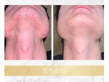 アンド エヌ(&n)/◆髭脱毛◆