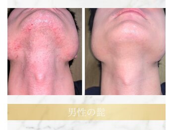 アンド エヌ(&n)/◆髭脱毛◆