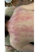 真心美/かっさ・カッピング後