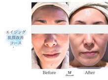 ディアスマイル(Dear.smile)/エイジング肌質改善コース