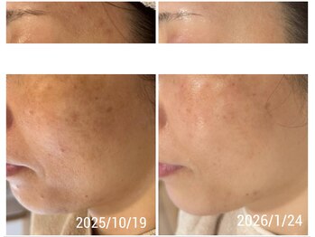 前田さんちのエステサロン ドゥース(douce.)/Before/after