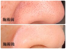 エピファニー(Epi phany Total Beauty Salon)の雰囲気（男性/女性にも人気のピーリング角質毛穴レスケア。美白にめ効果）