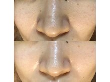 【医療提携】肌改善専門店Luanaハーブピーリング/毛穴/毛穴洗浄/ニキビケア/小顔/痩身の雰囲気（毛穴悩みに特化したメニュー多数取り扱い◆憧れの毛穴レス肌に）