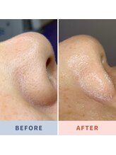 ソリス ビューティー(SOLIS BEAUTY)/毛穴洗浄