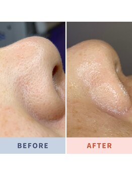 ソリス ビューティー(SOLIS BEAUTY)/毛穴洗浄