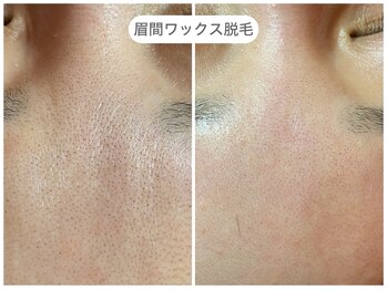 フラックス 京都(FLUX)/【ワックス脱毛】眉間