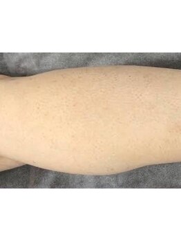 ムダ毛ケアをしたい