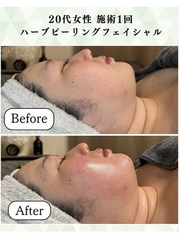 シーフェイス 横浜店(SEE FACE)/毛穴ケアハリツヤ肌トーンアップ