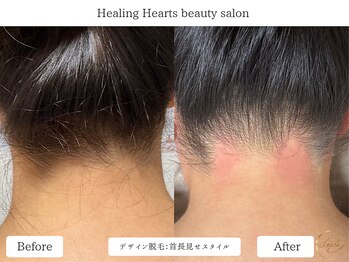 ヒーリングハーツ(Healing Hearts)/うなじ美人デザイン脱毛
