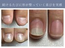 継続ケアで爪の形が整います