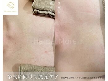 スキニティ 池袋(sknity)/<背中>ドレスの似合うなめらか肌