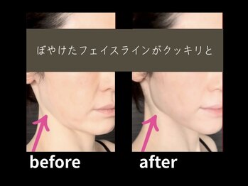 デスティン(DESTIN)の写真/【小顔リフトアップ】気になるもたつきやたるみを徹底ケア◎スッキリ引き締まったフェイスラインを実現♪