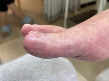 フットメンテ 巻き爪矯正センター 南浦和/肥厚爪施術後