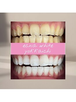 エクシアホワイトニング 四日市店/ホワイトニングビフォーアフター