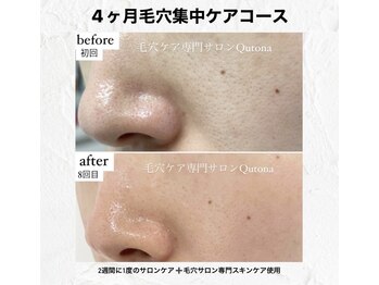 クトナ(Qutona)/根本的な毛穴ケアで肌質改善を☆