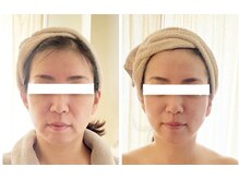 リュクス(Luxe)/小顔かっさビフォーアフター