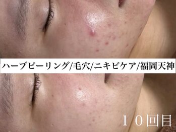 ホワイトアクア 福岡天神店(WHITE AQUA)/ハーブピーリングビフォー