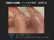 オンリィケア 関大前(ONLY CARE)/【メンズ毛穴洗浄】