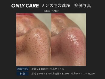 オンリィケア 関大前(ONLY CARE)/【メンズ毛穴洗浄】