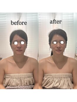 ジョワ 黒崎店(joie)の写真/【人気No.1】小顔フルコース！美肌効果でお肌の透明感アップ◎まずはこちらで美肌の土台作り♪