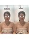 ジョワ 黒崎店(joie)の写真/【人気No.1】小顔フルコース！美肌効果でお肌の透明感アップ◎まずはこちらで美肌の土台作り♪