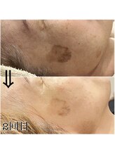 ランソ ビューティー 成田(RUNSO Beauty)/シミケアに♪ララピール