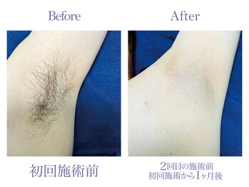 ツルツル美肌脱毛/【メンズ脱毛】わき脱毛