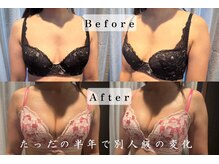 エステティックサロン パヒューム(Esthetic Salon Perfume)/長年のコンプレックス解消☆