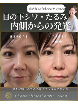 シェリー(Cherie)/目の下シワ・たるみ改善