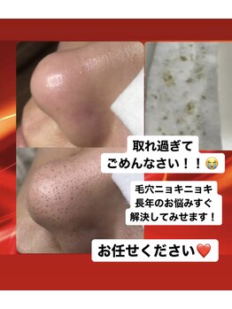 トータルビューティーサロン 琉月/エクストラクション　