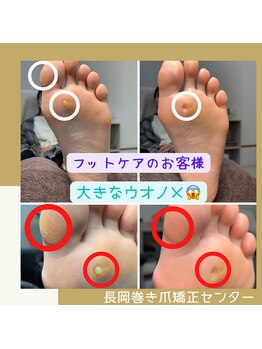 長岡巻き爪矯正センター/フットケアビフォーアフター