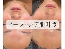 サロンドエテ(salon de ete)/肌水分爆上げノーファンデ肌