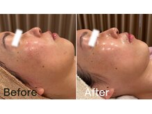 グレイス 高槻店(GRACE)/乳酸ピール3回目/結果写真