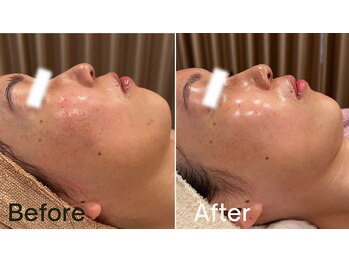 グレイス 高槻店(GRACE)/乳酸ピール3回目/結果写真