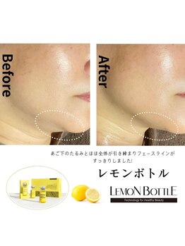エスプリ 銀座店/レモンボトル・小顔脂肪分解