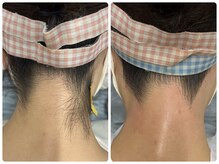 サロン ラズリ(SALON Lazuli)の雰囲気（ワックスと光のうなじ/VIO人気【佐賀/脱毛/痩身/毛穴/肌質改善】）