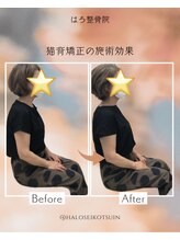 はろ整骨院/猫背・反り腰/巻き肩矯正
