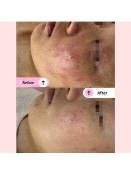 アネラ(ANELA)/赤み　痒み